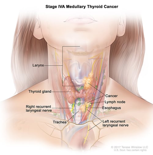 thyroid-ca-medullary-stage-4A