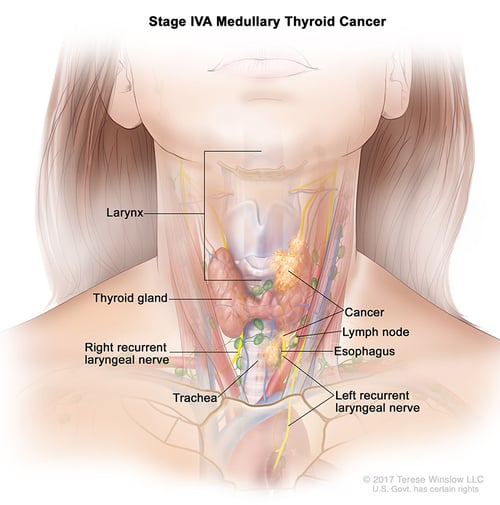tiroides-ca-medular-estadio-4A