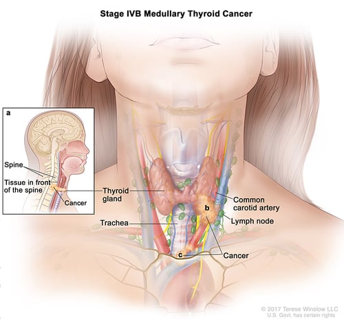 thyroid-ca-medullary-stage-4B