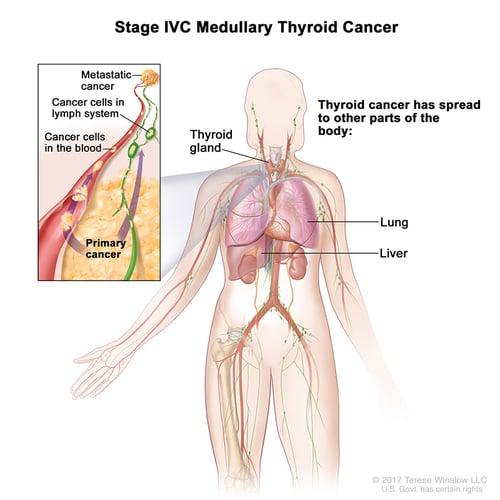 thyroid-ca-medullary-stage-4C