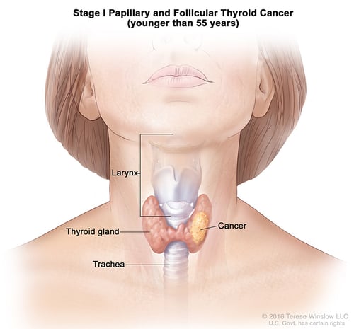 thyroid-ca-papillary-follicular-stage-1-55under (1)