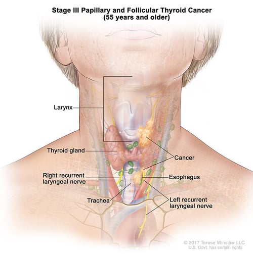 щитовидная железа-ка-папиллярно-фолликулярная-стадия-3-55овер