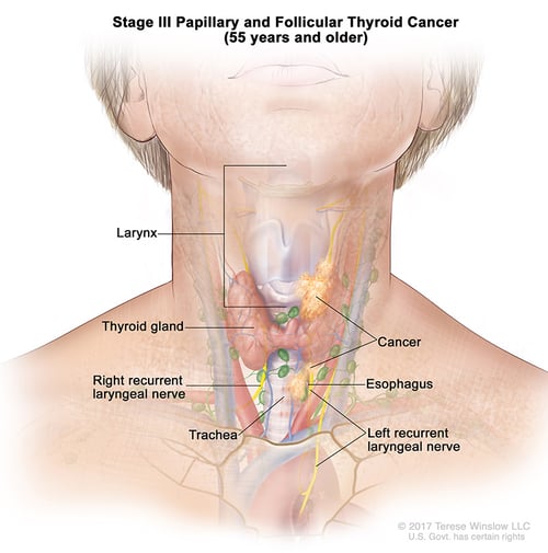 thyroid-ca-papillary-follicular-stage-3-55over