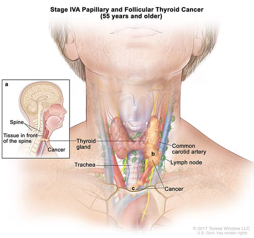 tiroides-ca-papilar-estadio-4A-55over