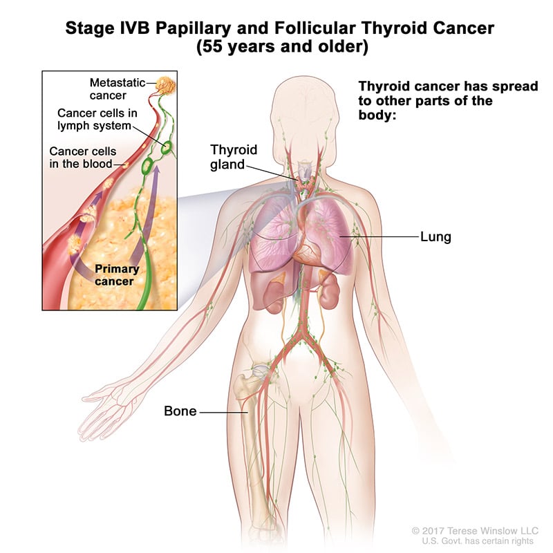 Thyroid Cancer Staging
