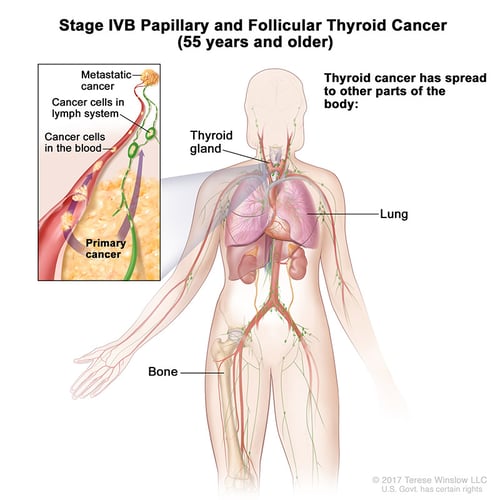thyroid-ca-papillary-follicular-stage-4B-55over