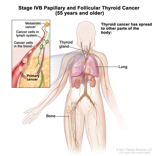 tiroides-ca-papilar-estadio-4B-55over
