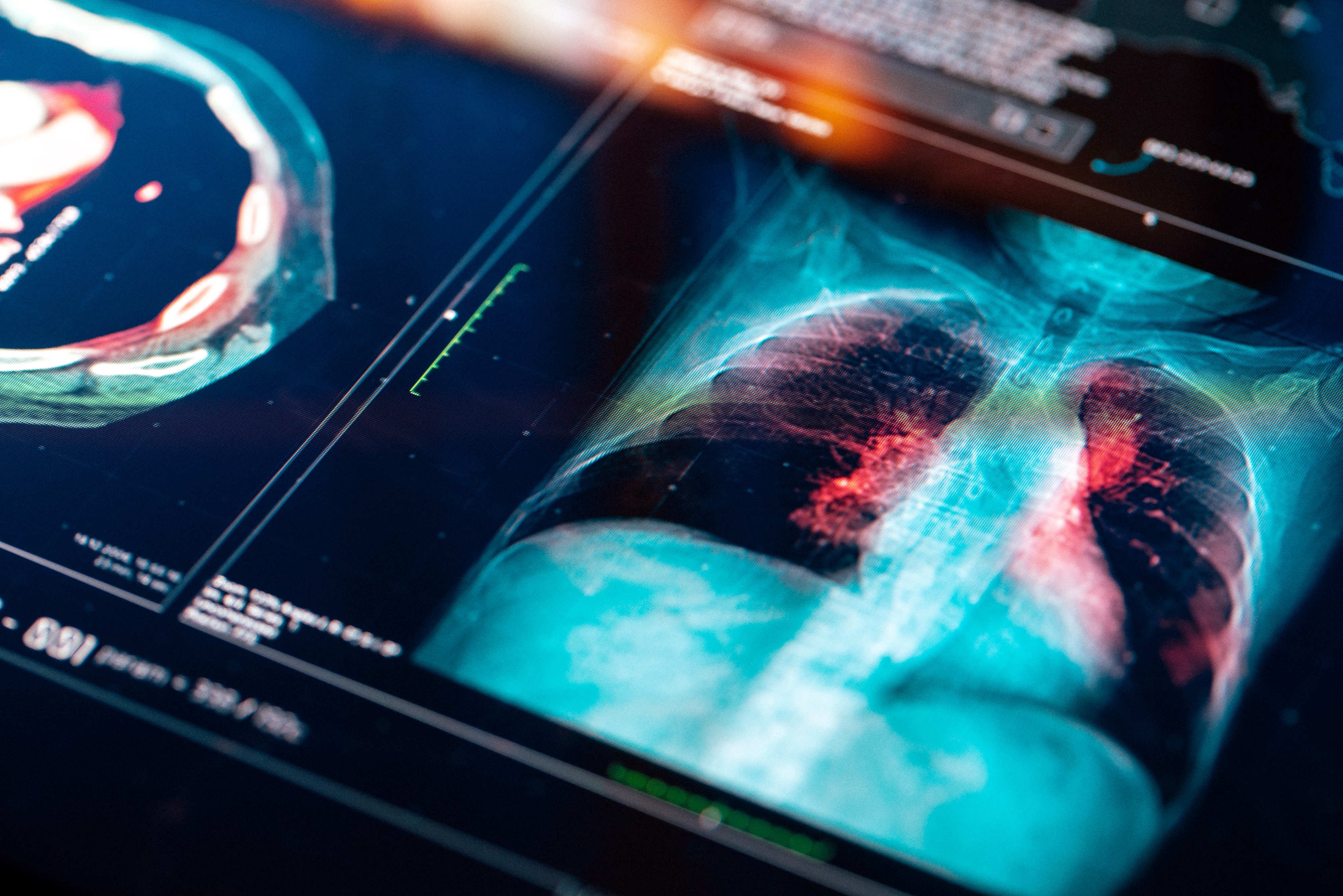 Precision Therapy for Lung Cancer Treatment