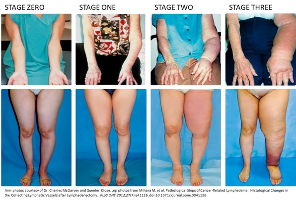 Lymphedema Stages Lymphedema Stages