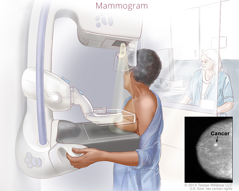 breast mammogram breast mammogram