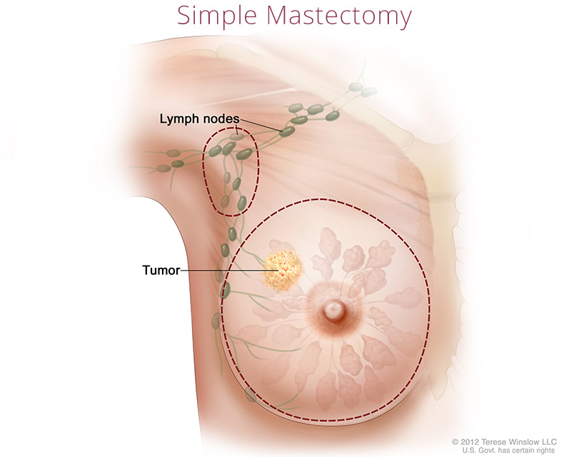 breast simple mastectomy