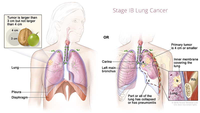 Lung Cancer Stage IB