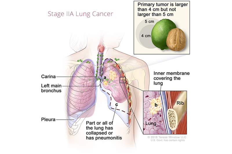 Lung Cancer Stage IIA