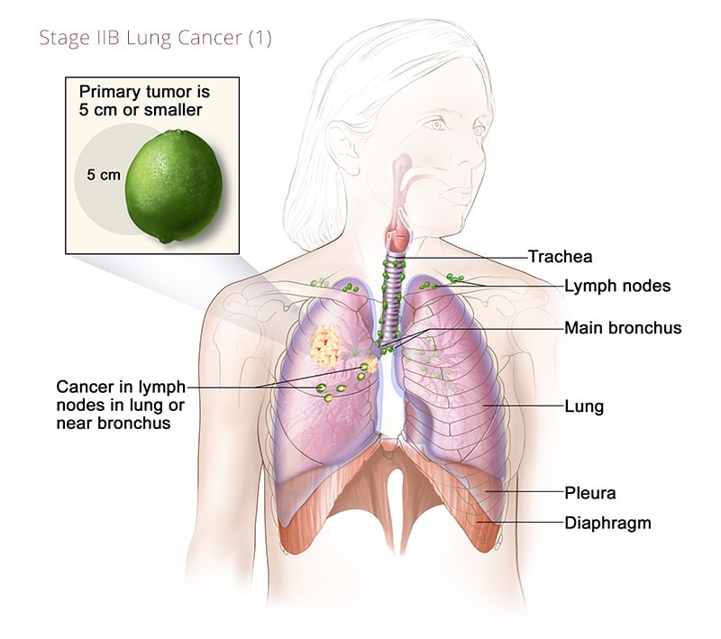 Lung Cancer Stage IIB 1