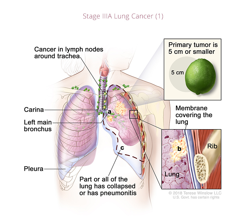 Lung Cancer Stage IIIA 1