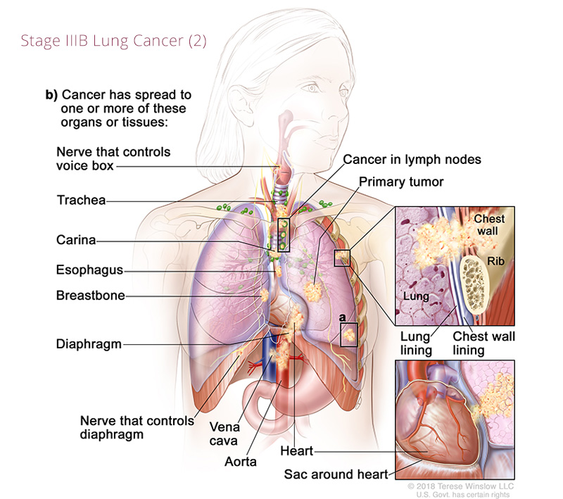 Lung Cancer IIIB 2