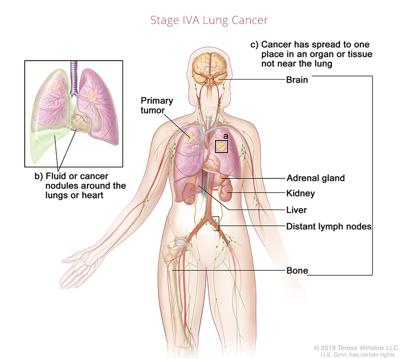 Lung Cancer Stage IVA