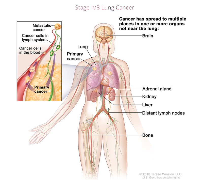 Lung Cancer Stage IVB