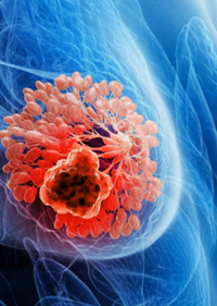 Los ADC dirigidos contra TROP2 están a punto de revolucionar el tratamiento de primera línea del cáncer de mama triple negativo